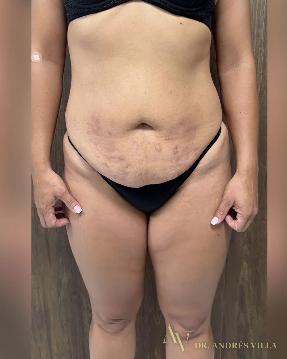 Lipoabdominoplastia circunferencial. Frontal de pie · antes y después.