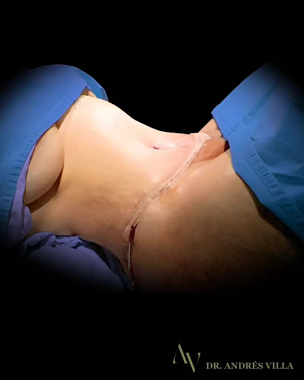 Lipoabdominoplastia extendida. Después · contorno abdominal.