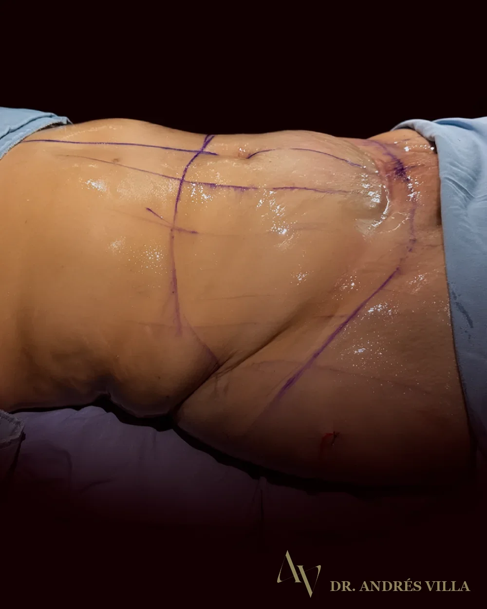 Abdominoplastia con lipotransferencia glútea. Después · contorno abdominal.