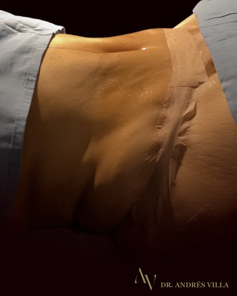Abdominoplastia con lipotransferencia glútea. Antes · marcación prequirúrgica.