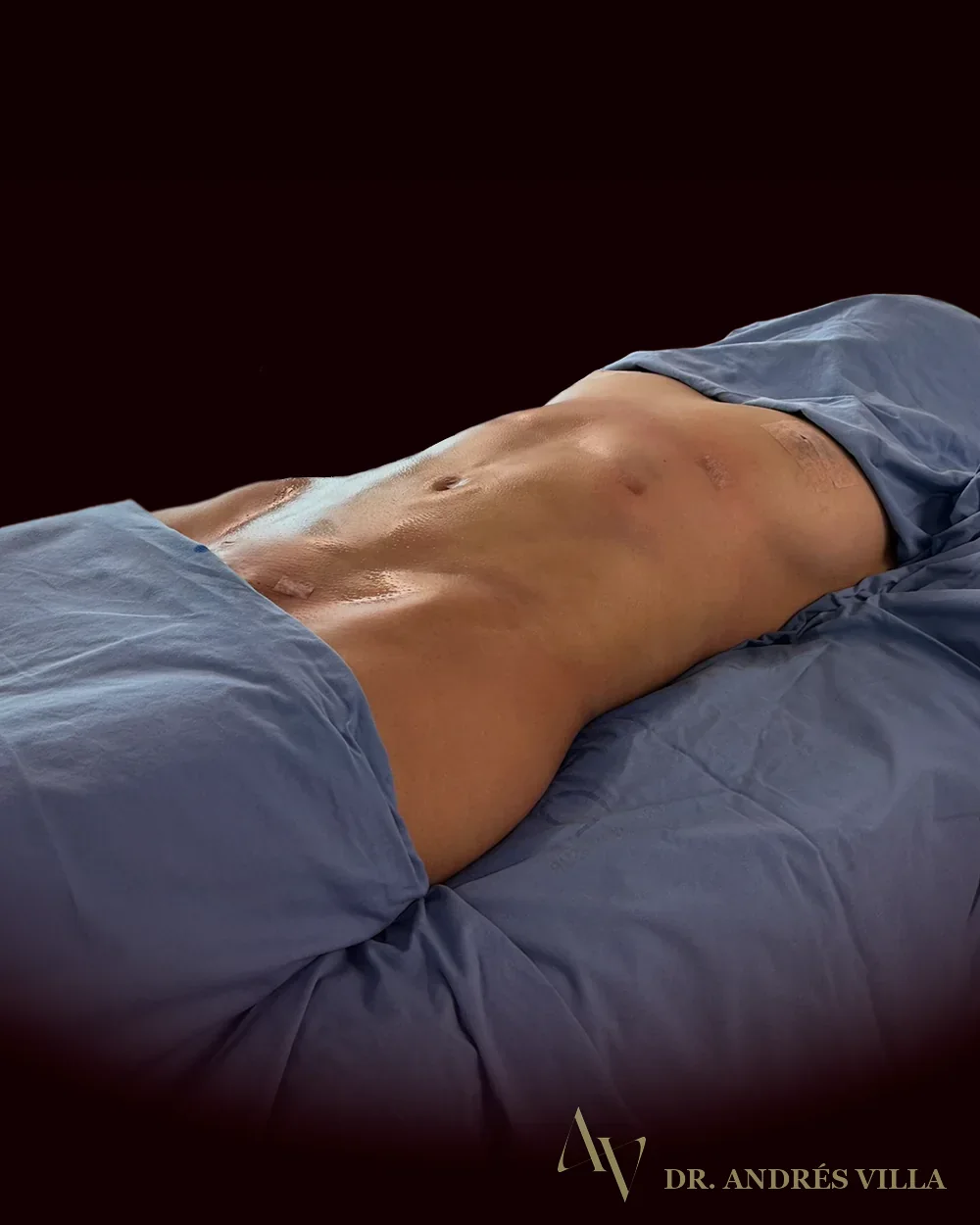 Liposucción con lipotransferencia glútea. Registro en quirófano.