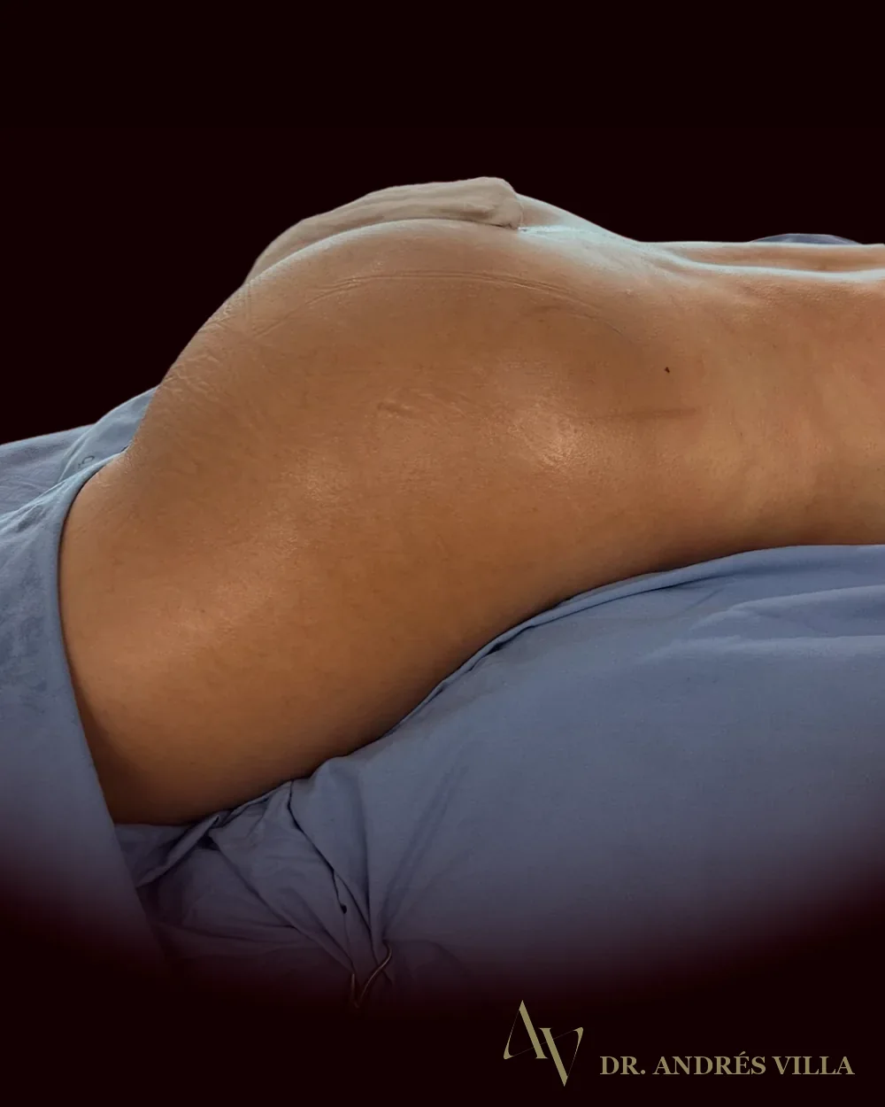 Liposucción con lipotransferencia glútea. Registro en quirófano.