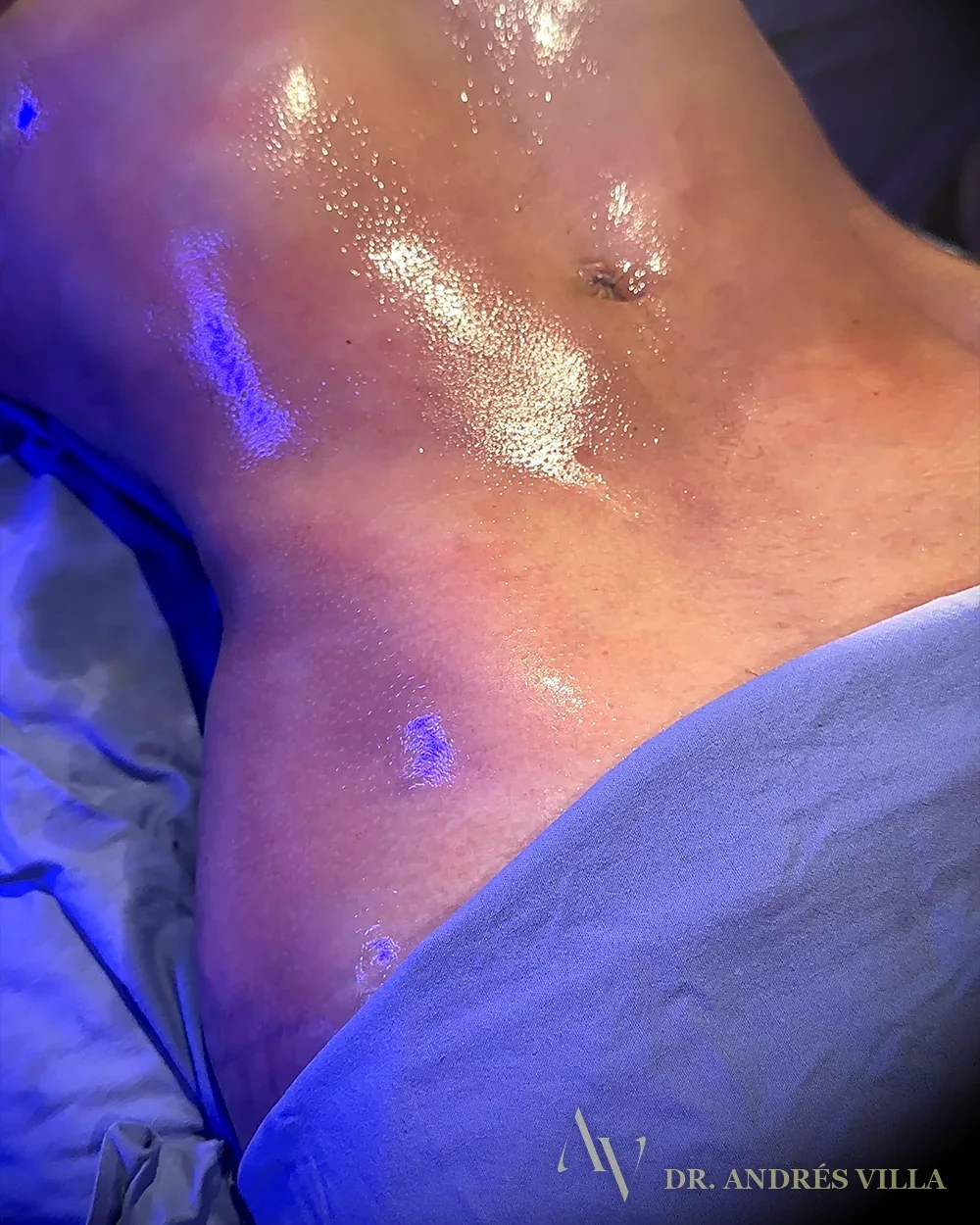 Lipomarcación abdominal. Registro en quirófano.