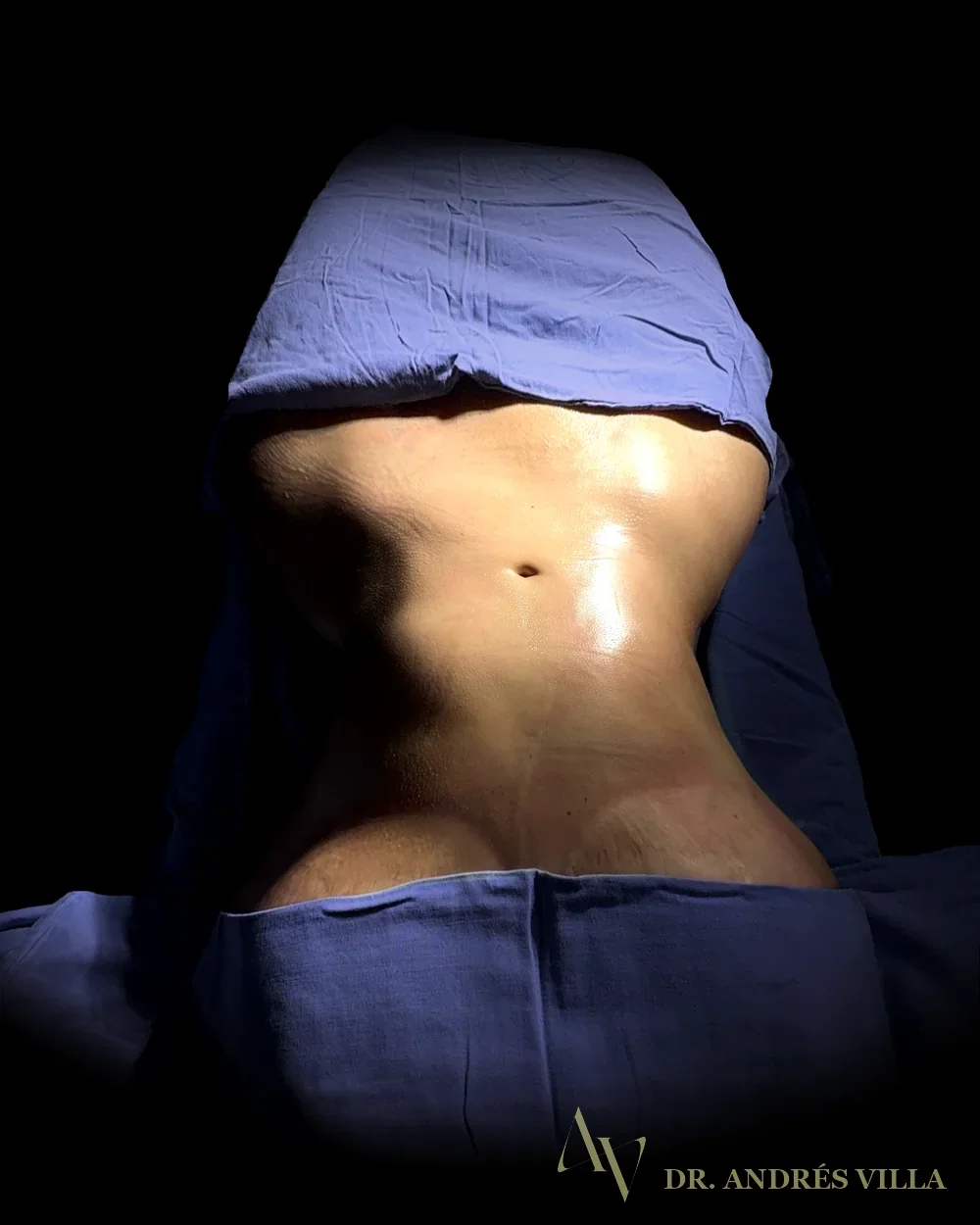 Liposucción de contorno. Registro en quirófano.